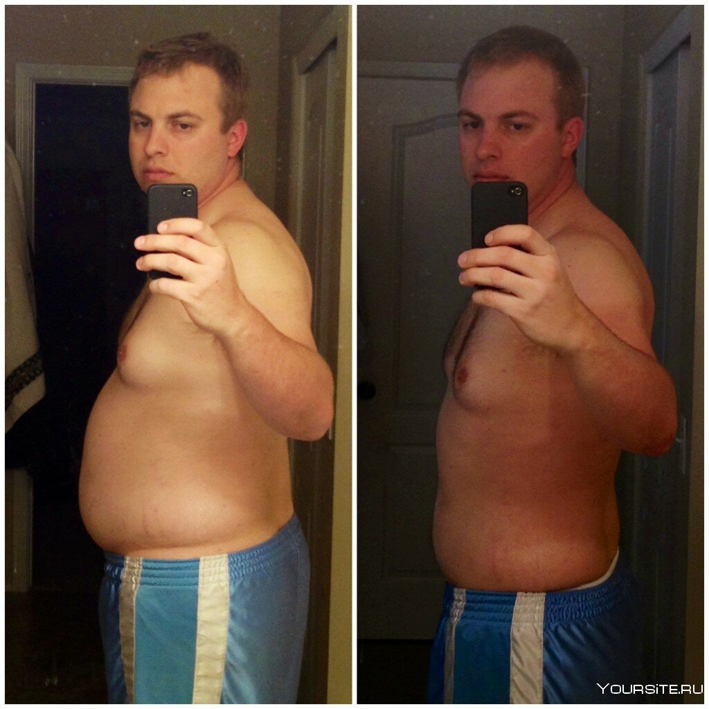 Живот до и после похудения
