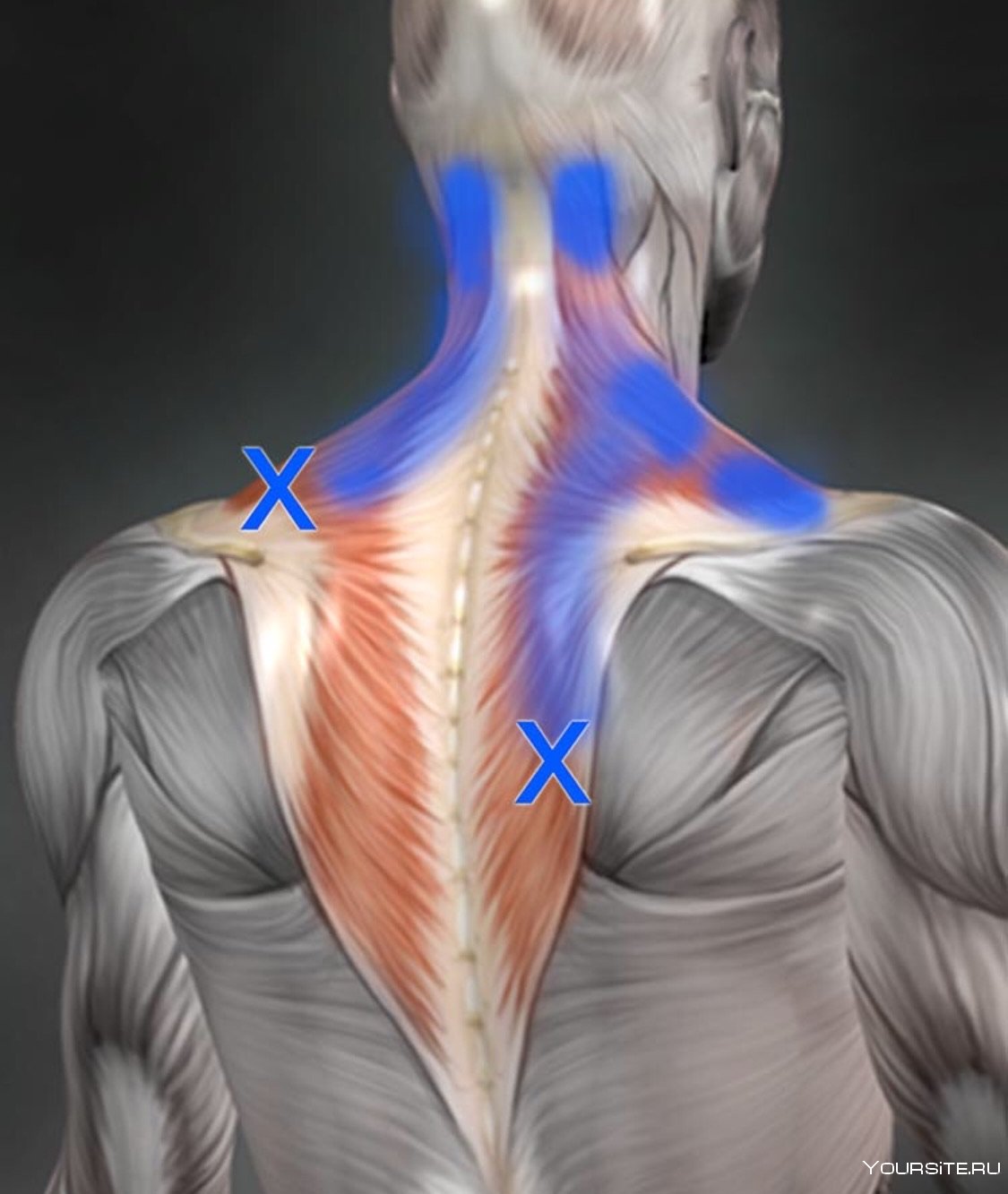Затылок шею плечи. Ромбовидная мышца спины триггерные точки. Триггерные точки в мышцах спины. Трапециевидная мышца спины триггерные точки. Триггерные точки ромбовидной мышцы.