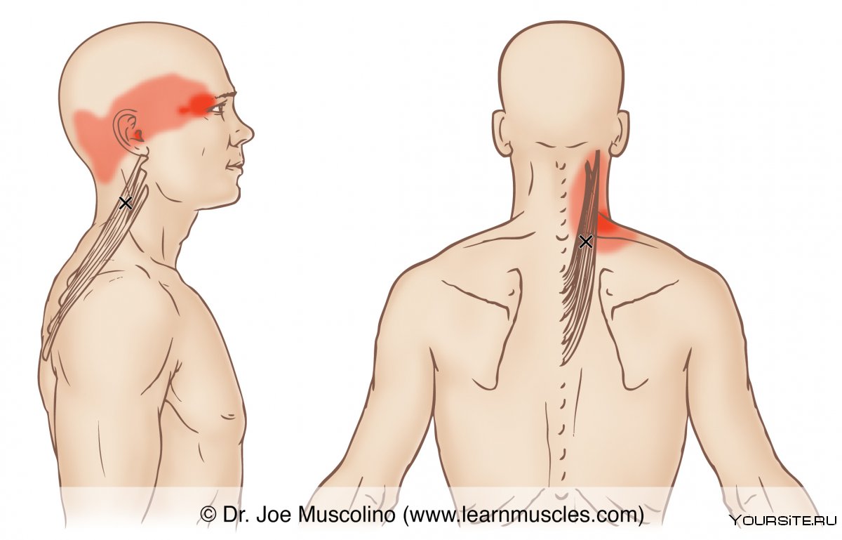 Воспаление ременной мышцы шеи