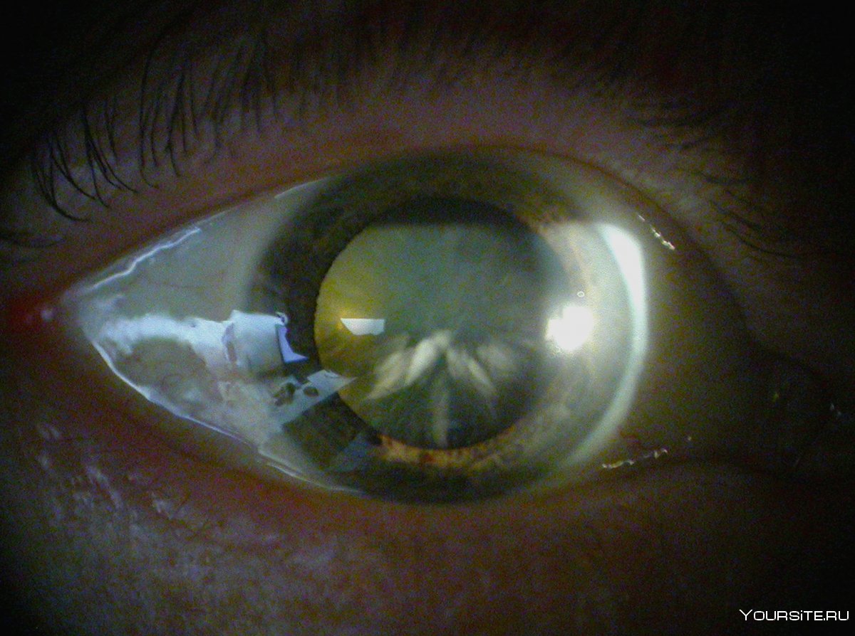 Тетаническая катаракта