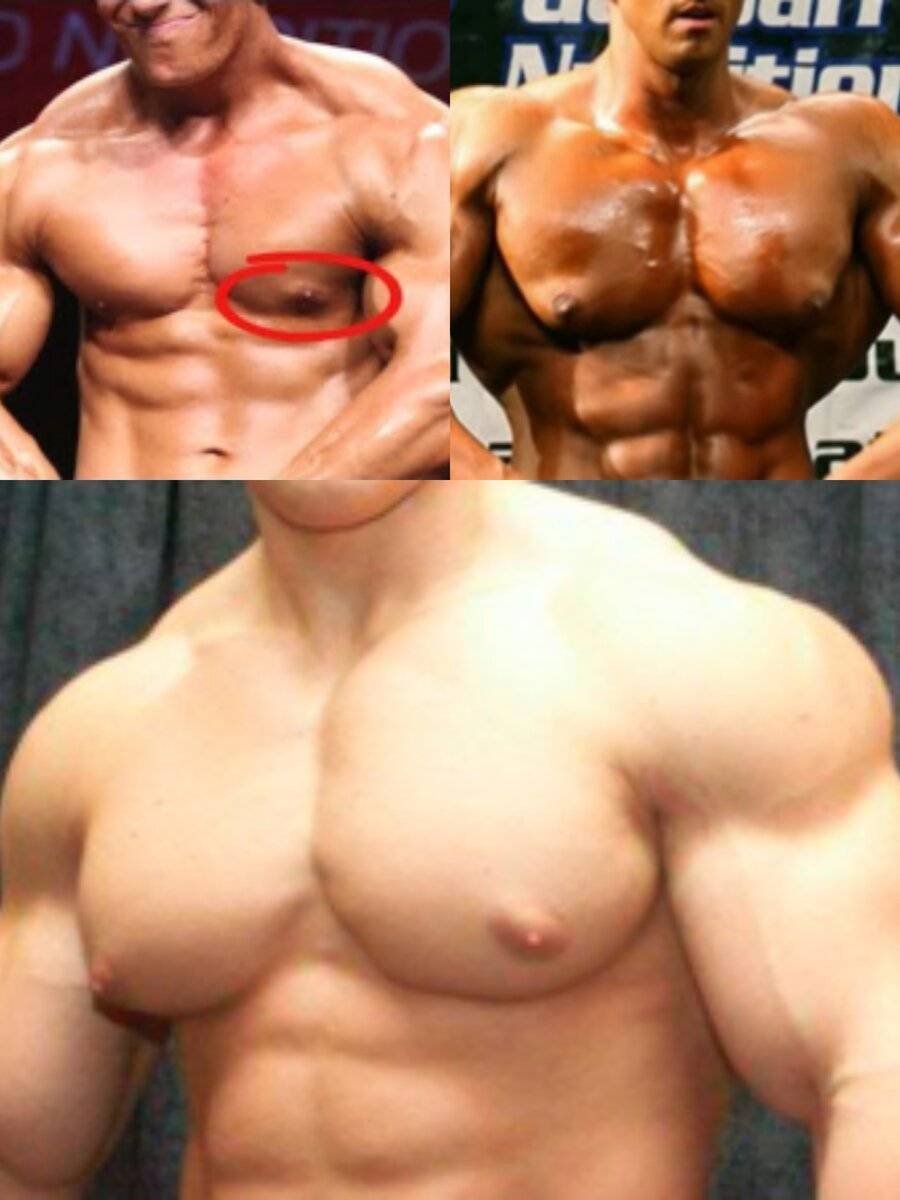 выросшая от гормонов грудь у мужчин фото 105