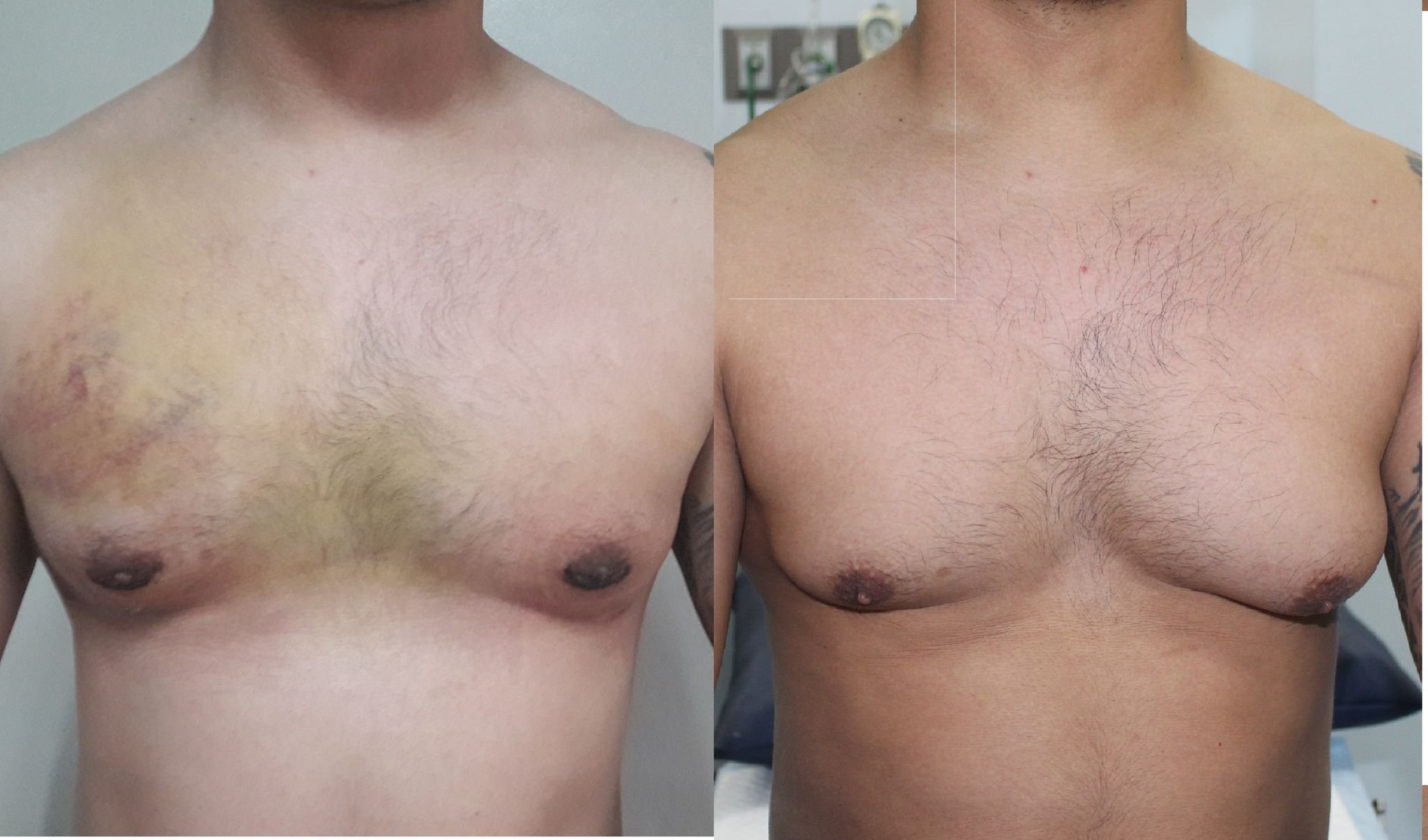 изменение груди у мужчин фото 109