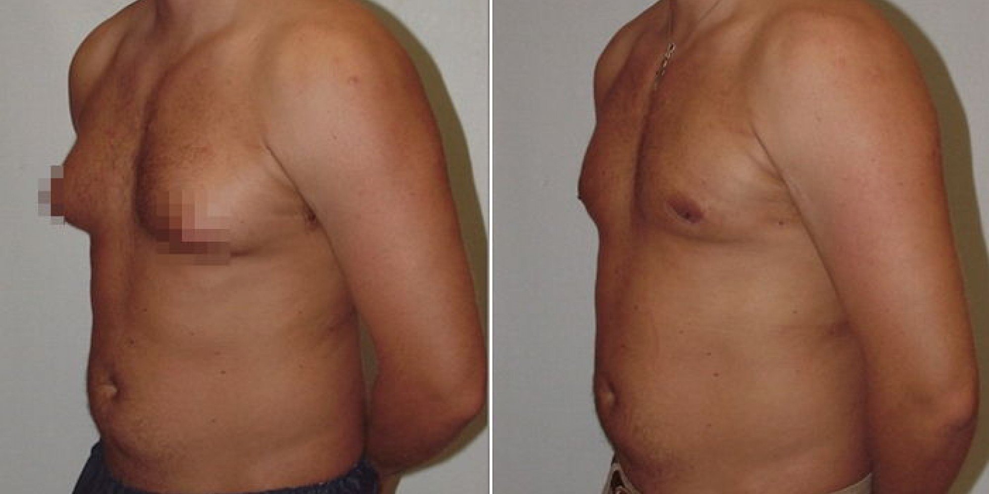 изменение груди у мужчин (119) фото