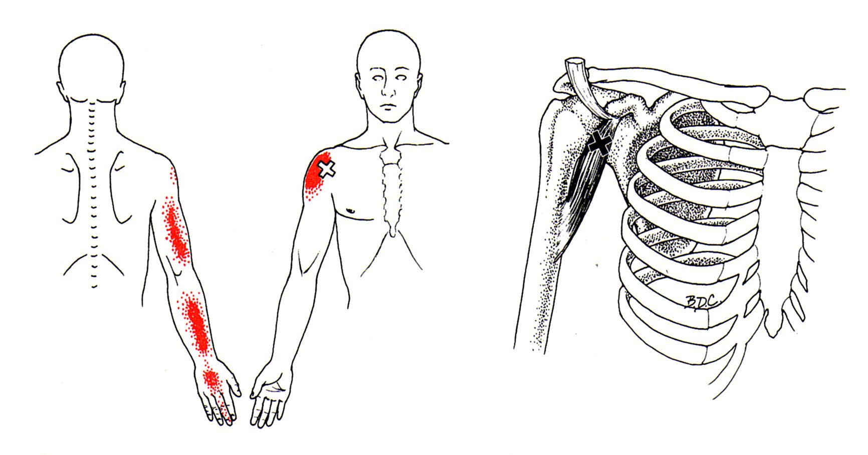 Иррадиация в левую лопатку. Подлопаточная мышца плеча триггерные точки. Триггерные точки в клювовидно-плечевая мышца. Триггерные точки плечевого сустава. Триггерные точки дельтовидной мышцы плеча.