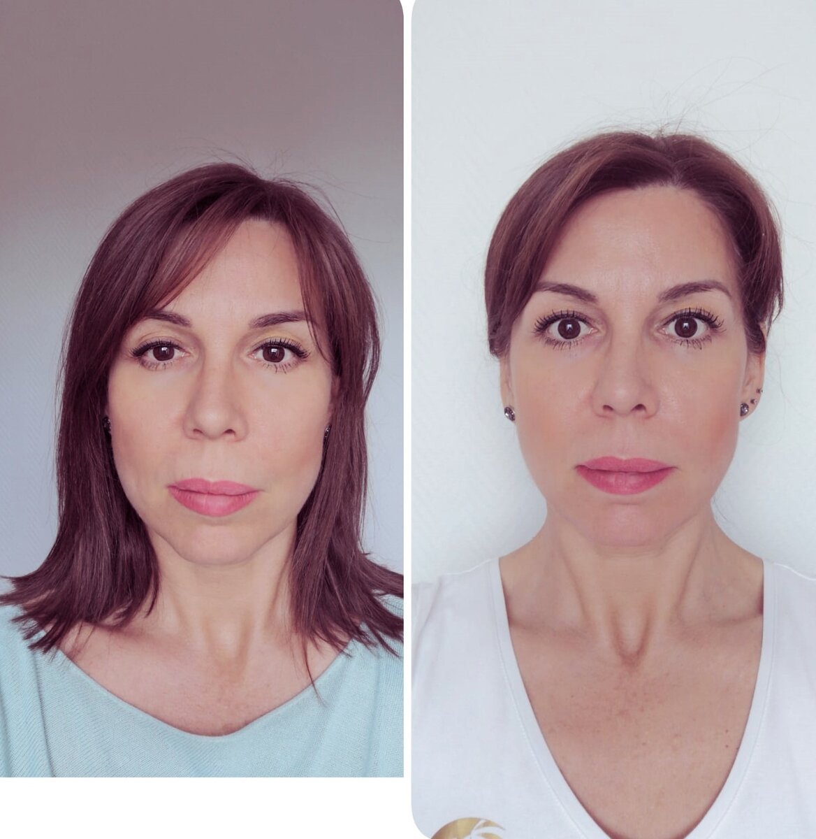 Асимметрия лица до и после