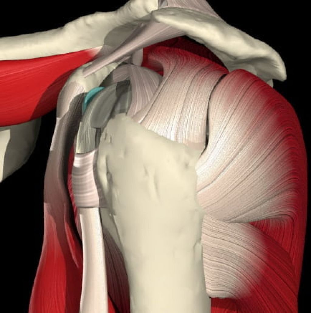 Тендинит мышцы плечевого сустава. Сухожилие подостной мышцы. Тендинопатия надостной мышцы плечевого сустава. Тендинит сухожилия надостной. Повреждения правого плечевого сустава