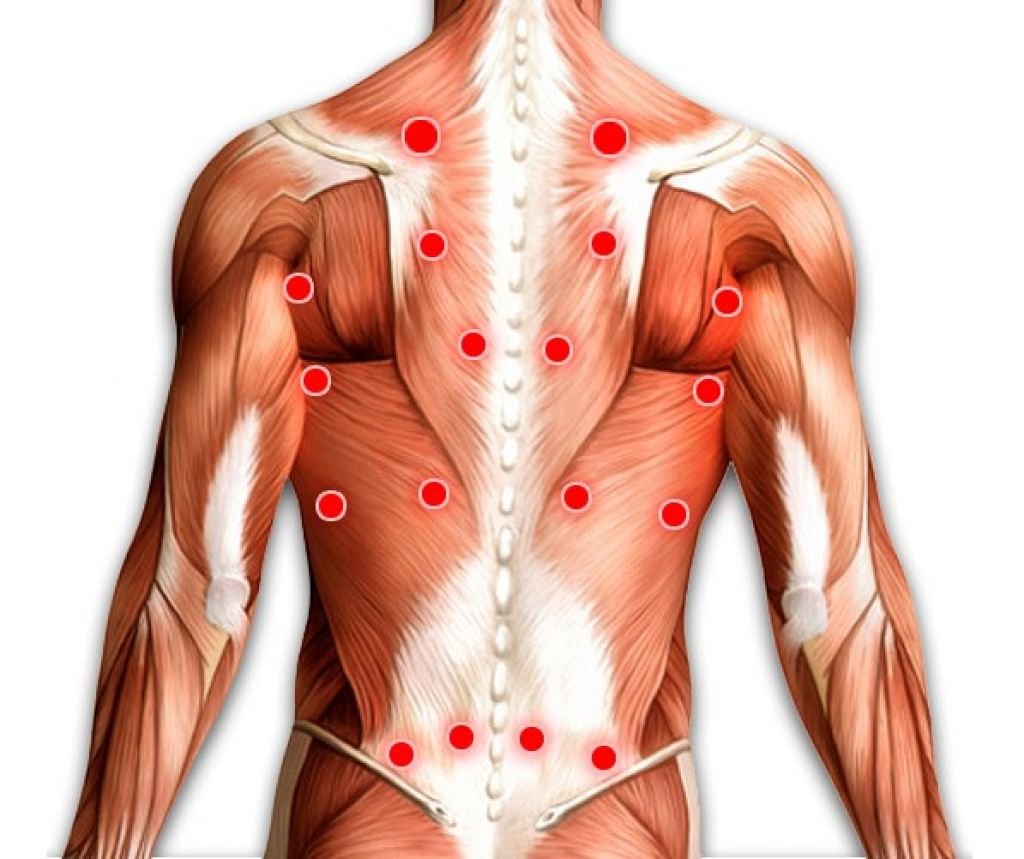 Триггерные точки в мышцах спины