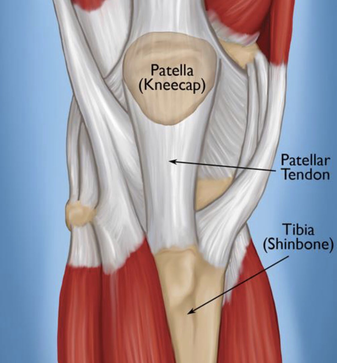 Боли в мышцах коленного сустава. Тендинита сухожилия Четырёхглавой мышцы. Разрыв сухожилия четырехглавой мышцы бедра. Повреждение сухожилия четырехглавой мышцы. Сухожилие четырехглавой мышцы бедра анатомия.