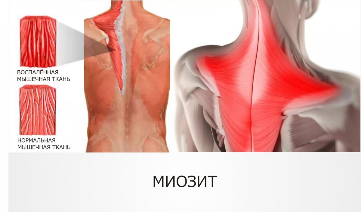 Воспаленные мышцы спины