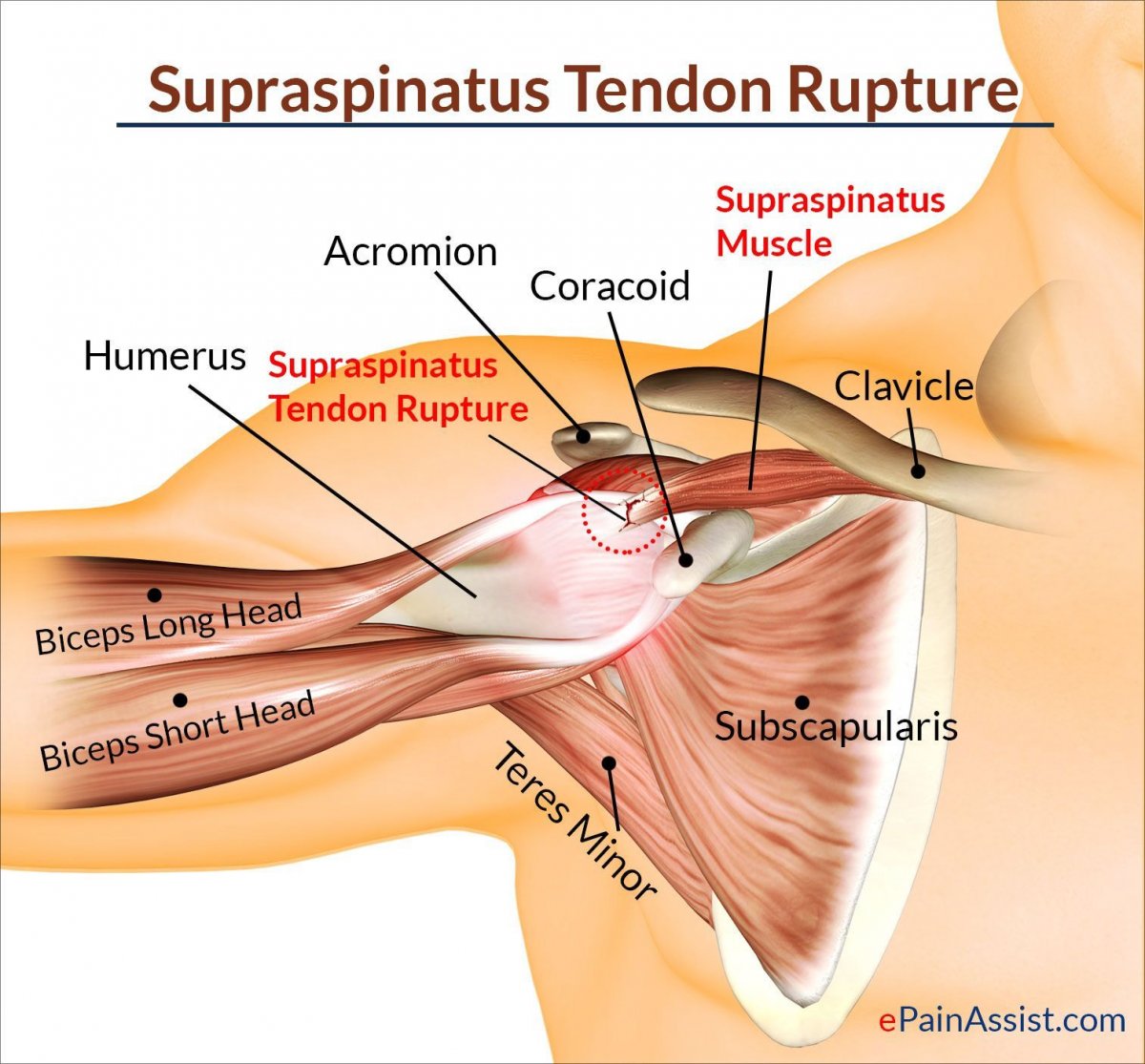 Тендинопатия сухожилия надостной мышцы плечевого