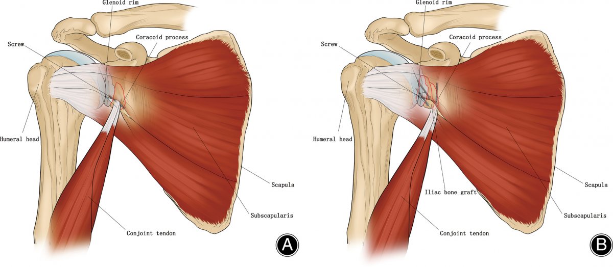 Плечевая мышца (m. brachialis)
