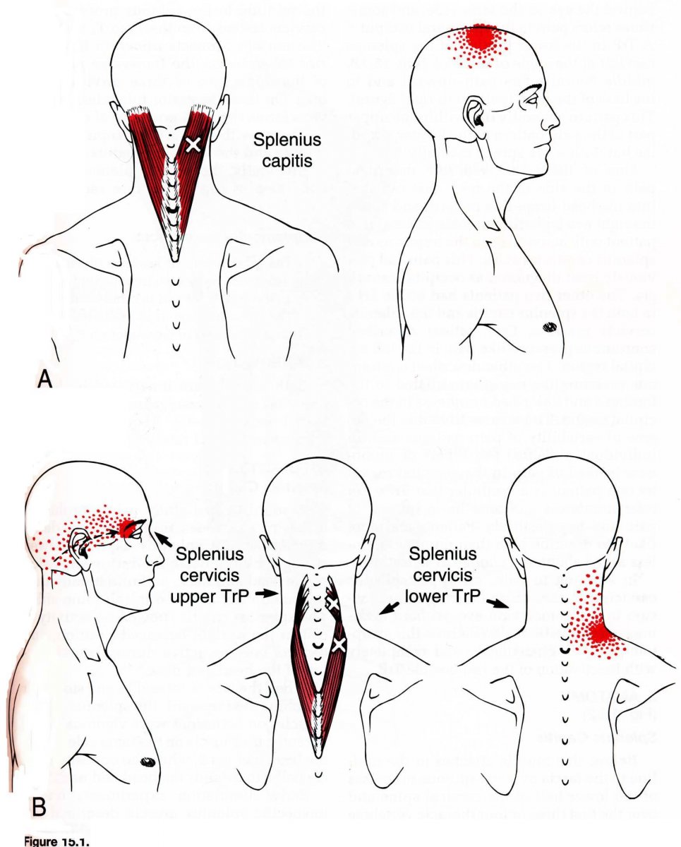 Семиспиналис капитис