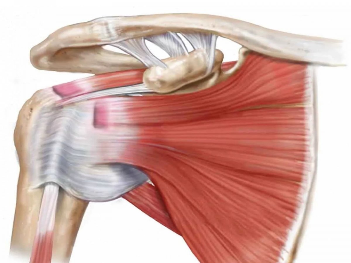 Разрыв сухожилия надостной мышцы плечевого
