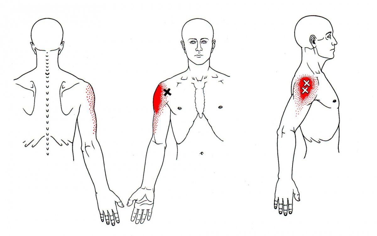 Триггерные точки дельтовидной мышцы