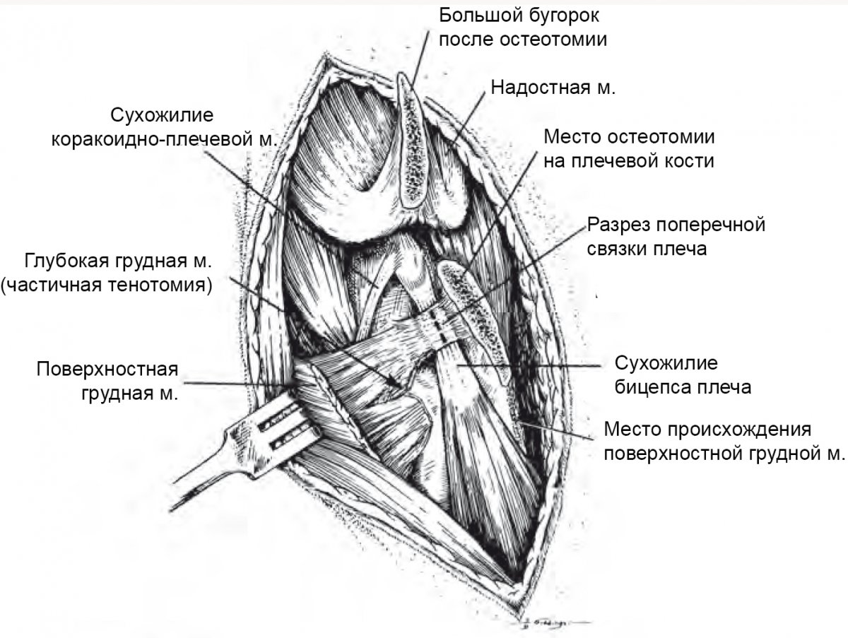 Biceps brachii мышца