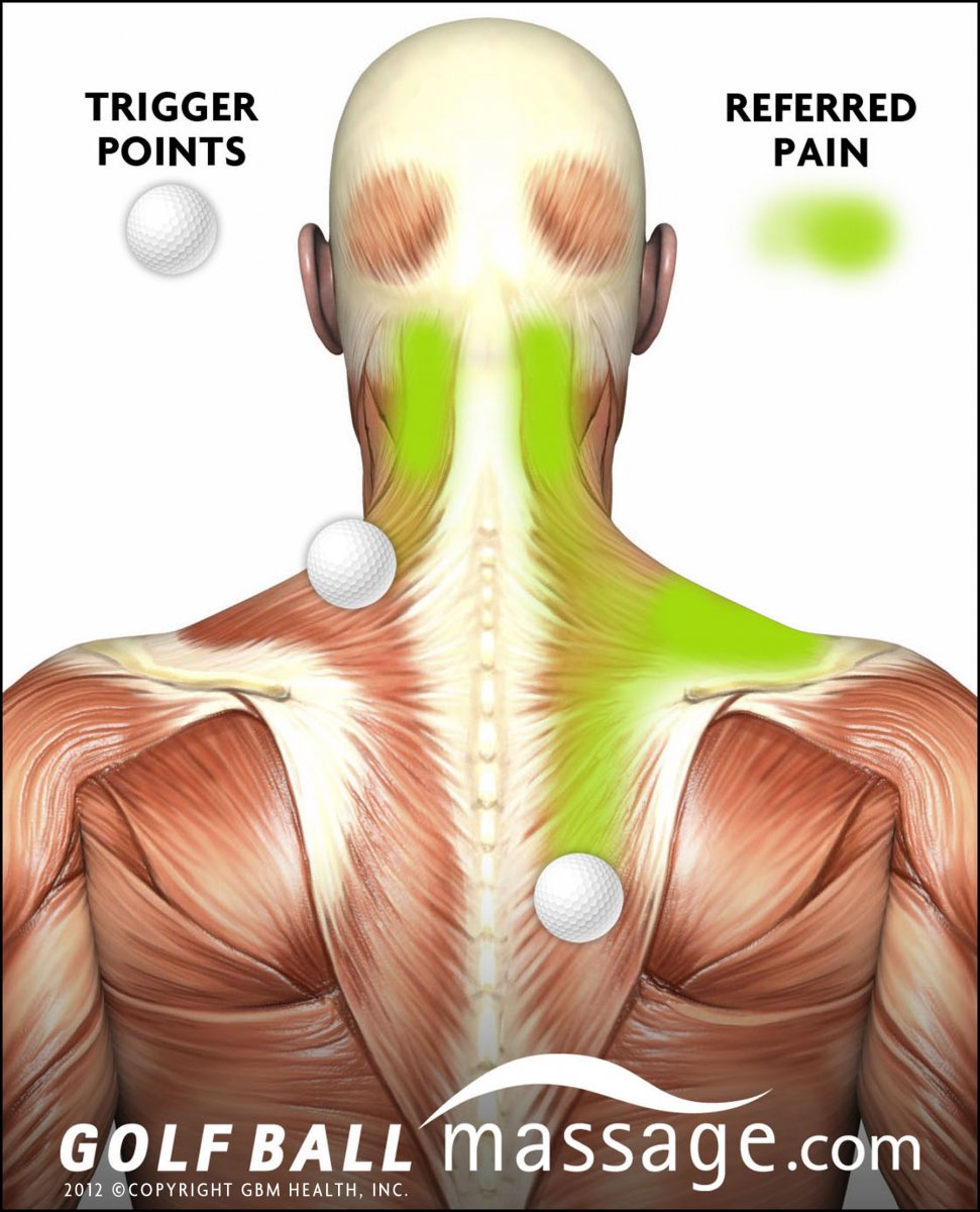 Триггерные точки в мышцах спины