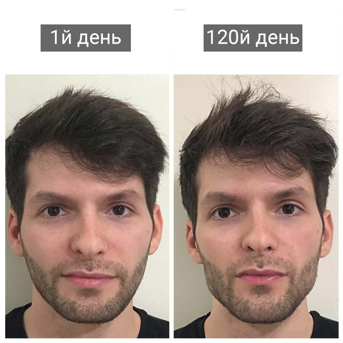 Скулы Мьюинг