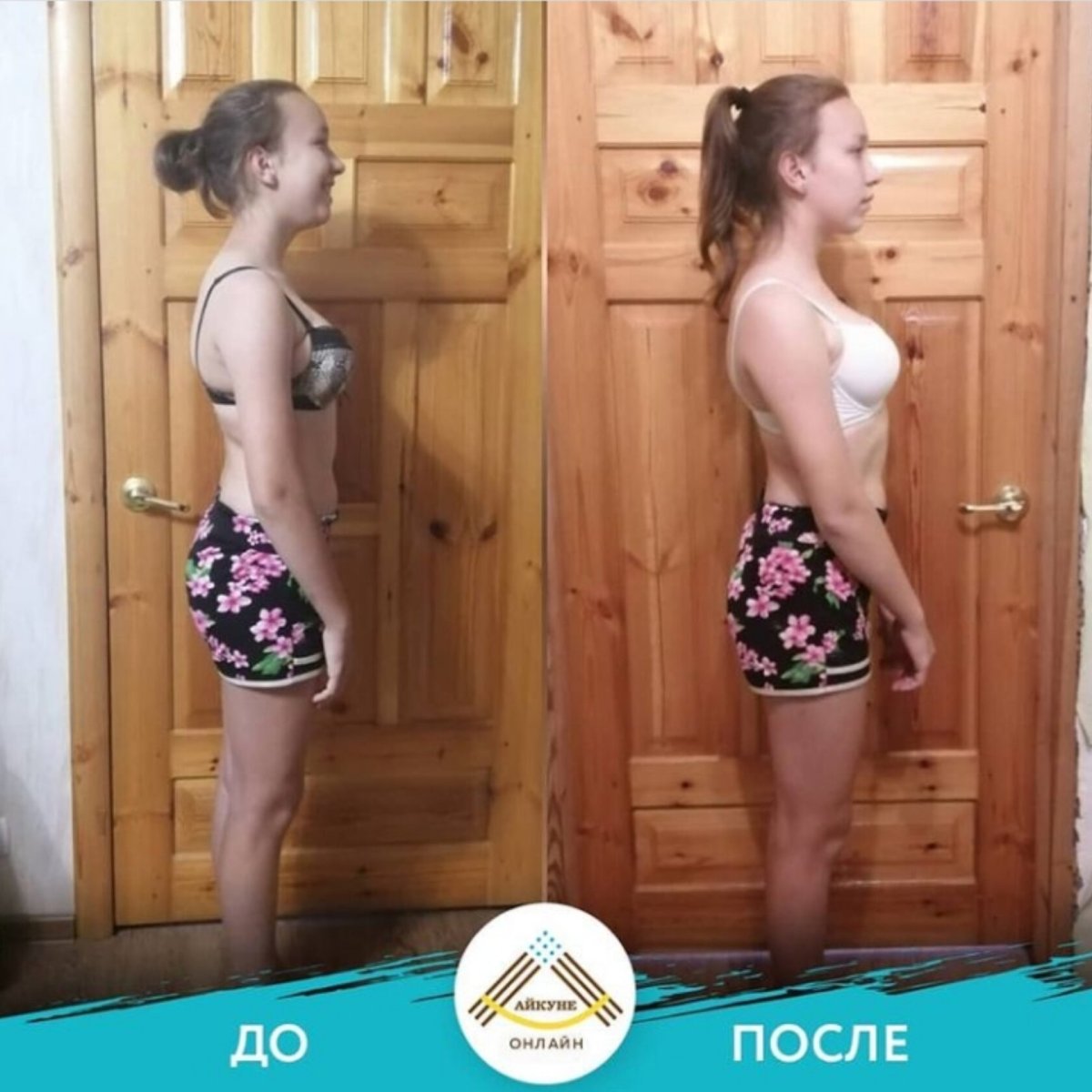 Сутулая спина у девушки