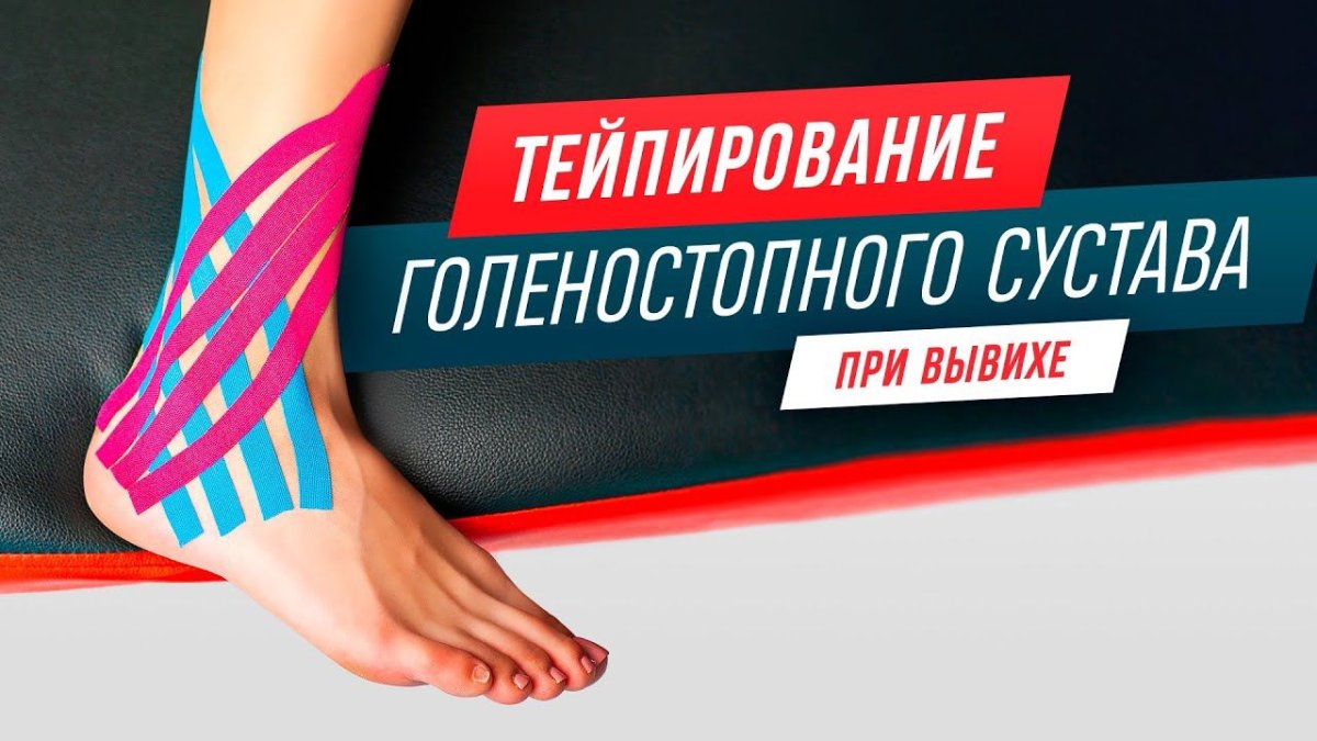 Бузова тейпирование