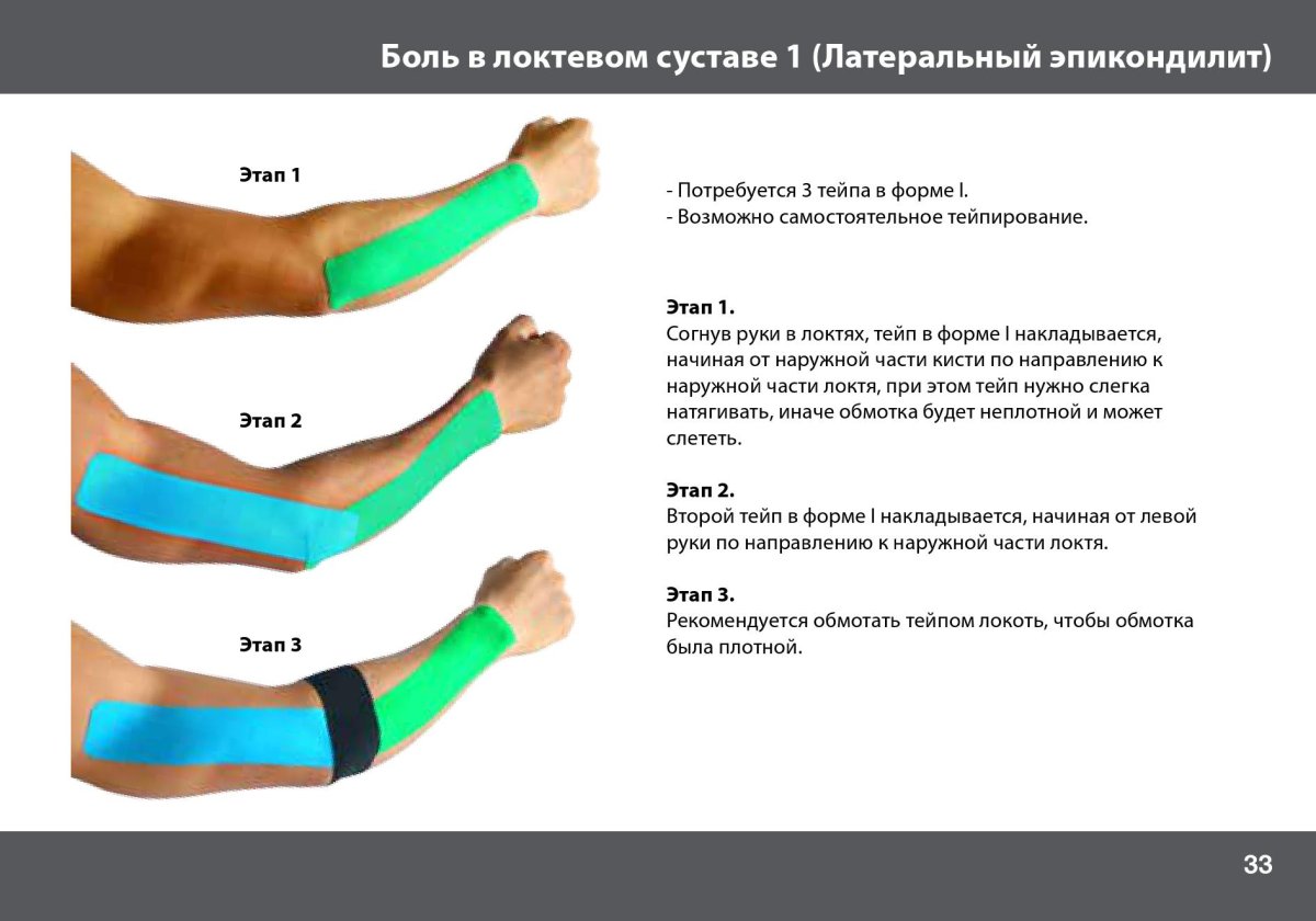 Тейпирование при эпикондилите локтевого