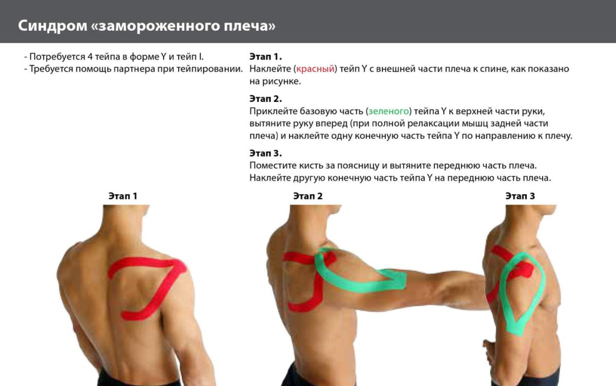 Схема тейпирования связок плечевого сустава