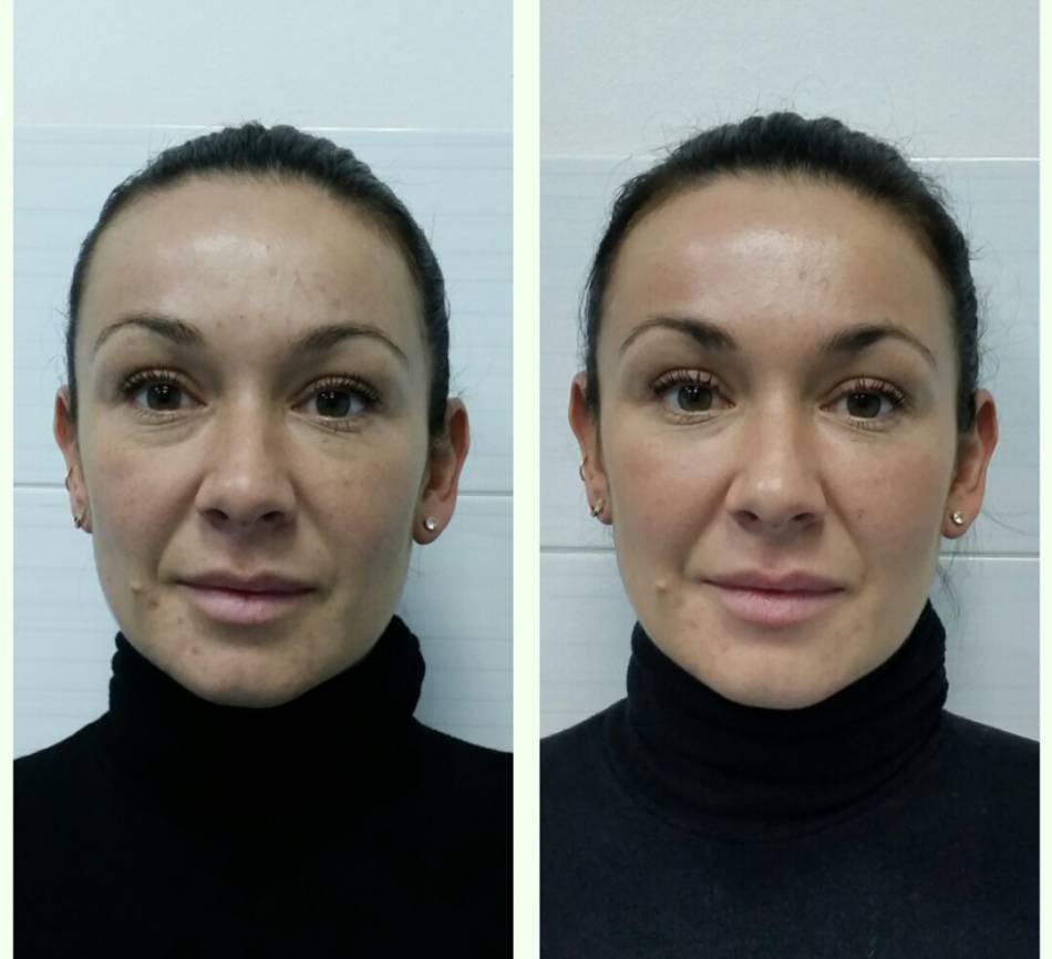 Лицо до и после массажа лица