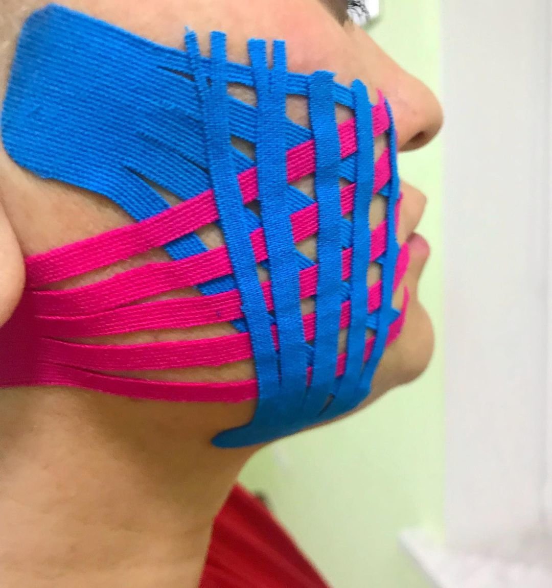 Кинезиотерапия тейпирование